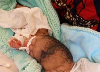 RDC: l’HGR Kabinda enregistre un cas des jumelles siamoises