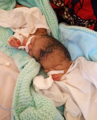 RDC: l’HGR Kabinda enregistre un cas des jumelles siamoises